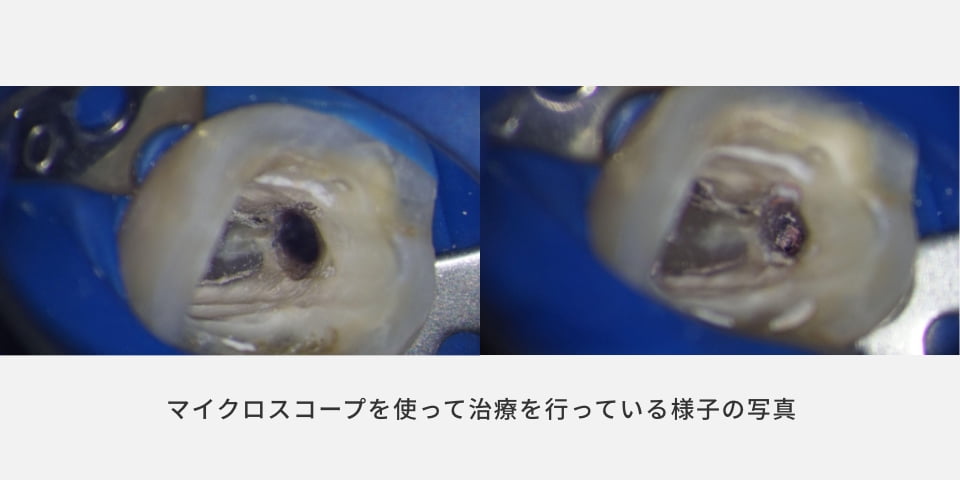 マイクロスコープを使った歯の根の治療