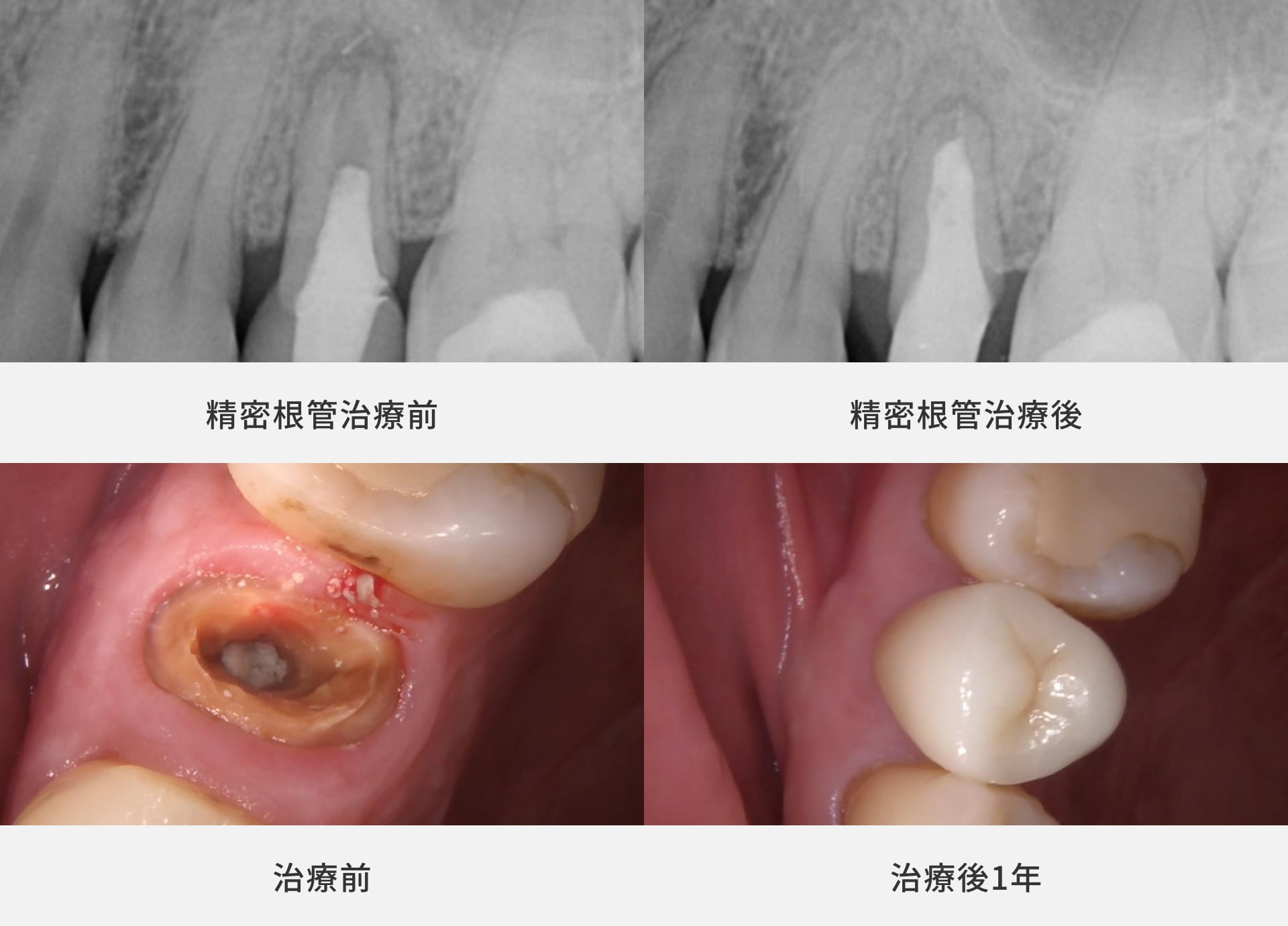 抜歯と言われた歯の再根管治療